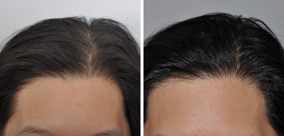 PRP Hair Restoration Results New Jersey