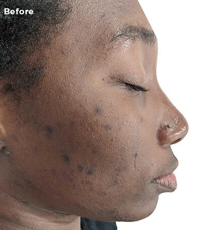 VI Peel case #2291