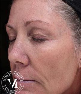 VI Peel case #2302