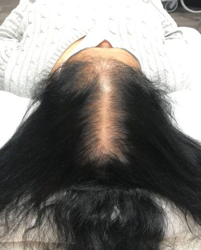 PRP Hair Restoration case #2202