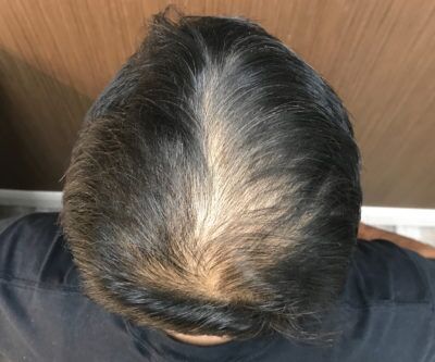 PRP Hair Restoration case #2199