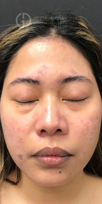 SkinPen Microneedling case #2263