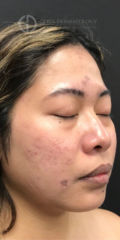 SkinPen Microneedling case #2263