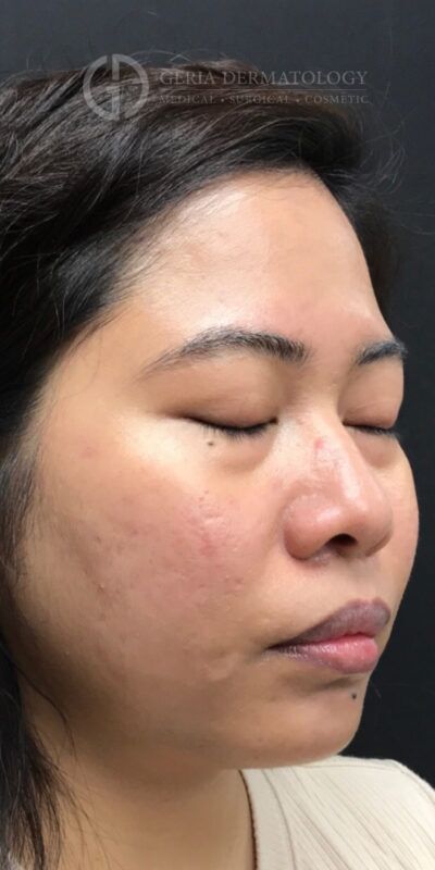 SkinPen Microneedling case #2263