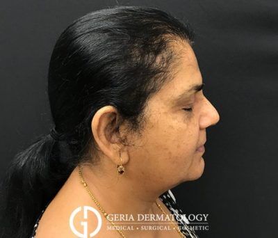 PRP Hair Restoration case #2196