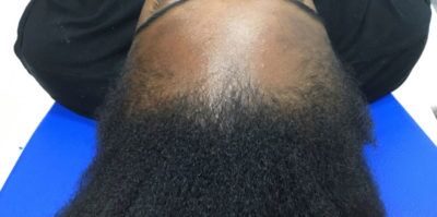 PRP Hair Restoration case #2171