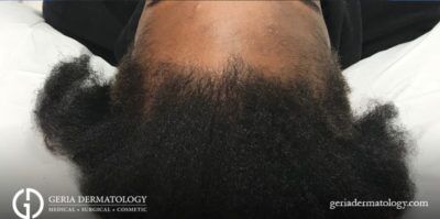 PRP Hair Restoration case #2171