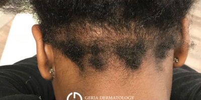 PRP Hair Restoration case #2171