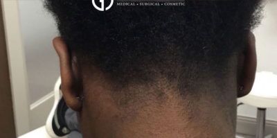 PRP Hair Restoration case #2171