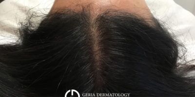 PRP Hair Restoration case #2176