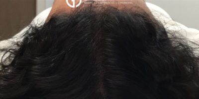 PRP Hair Restoration case #2176