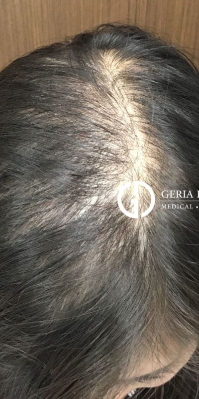 PRP Hair Restoration case #2181