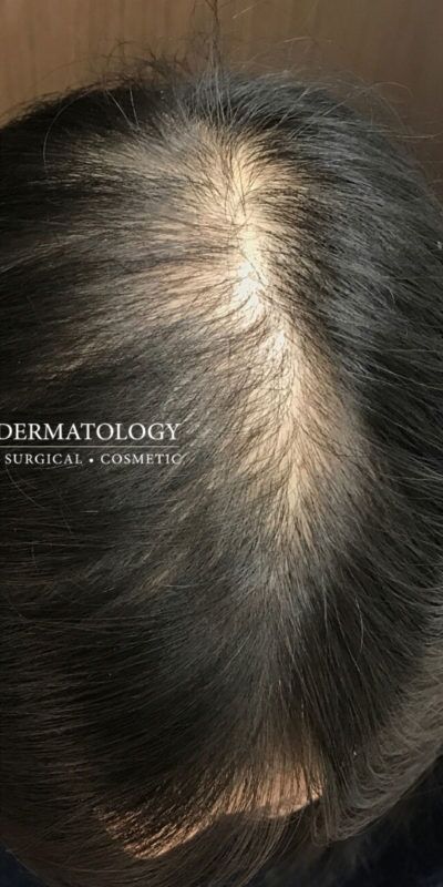 PRP Hair Restoration case #2181