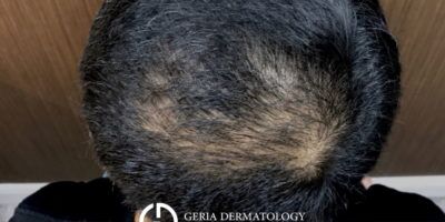 PRP Hair Restoration case #2190