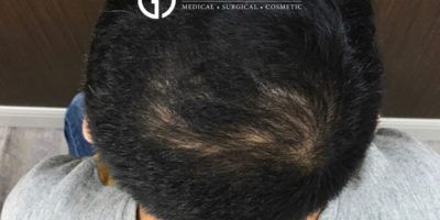 PRP Hair Restoration case #2190