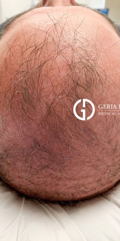 PRP Hair Restoration case #2193