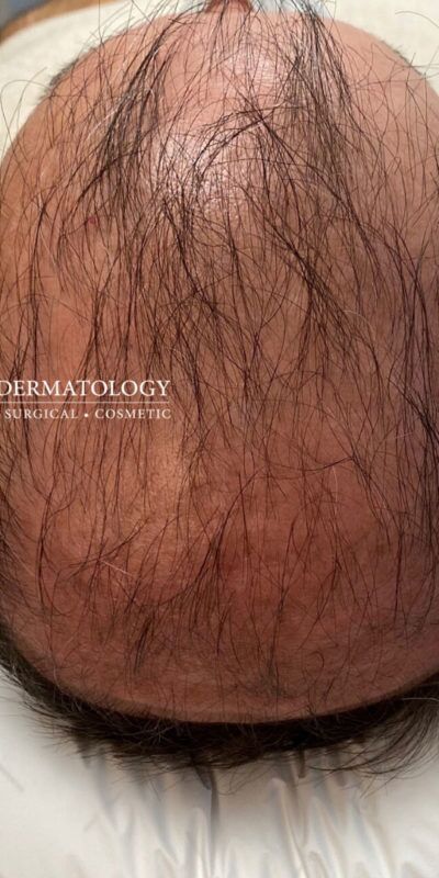 PRP Hair Restoration case #2193