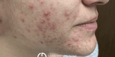 acne treatment Before and after dermatology results | Geria Dermatology New Jersey