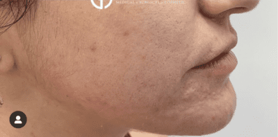 acne treatment Before and after dermatology results | Geria Dermatology New Jersey