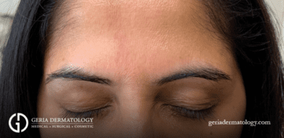 Botox/Dysport/Xeomin/Jeuveau case #1605