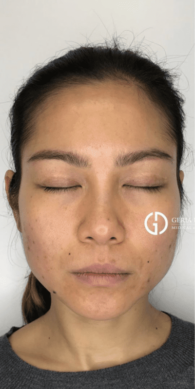 Botox/Dysport/Xeomin/Jeuveau case #1608