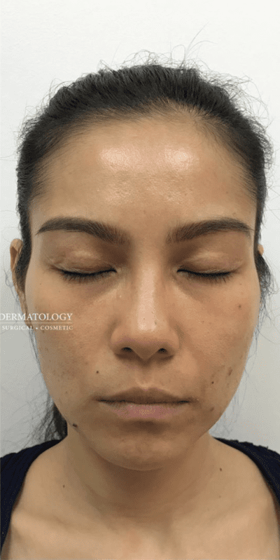 Botox/Dysport/Xeomin/Jeuveau case #1608