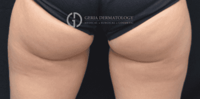 CoolSculpting case #1895