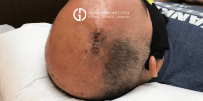 Cyst Removal case #1903