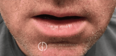 Skin Treatment Before and After Results | Geria Dermatology New Jersey