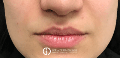 Lip Filler case #2130