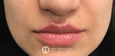 Lip Filler case #2130