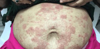 Psoriasis Treatment case #2234