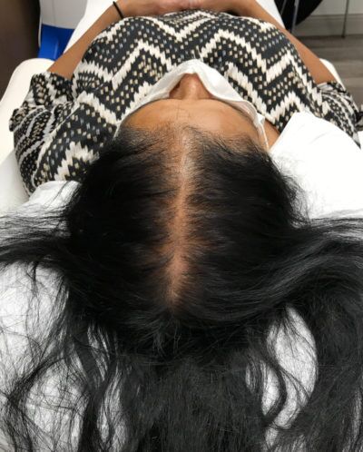 PRP Hair Restoration case #2202