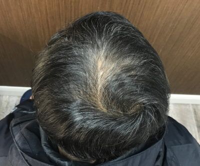 PRP Hair Restoration case #2199