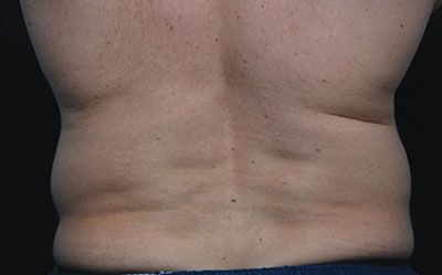 Coolsculpting Before and After Results | Geria Dermatology New Jersey