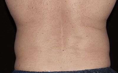 Coolsculpting Before and After Results | Geria Dermatology New Jersey