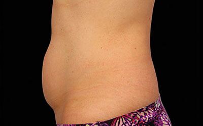 CoolSculpting case #1866