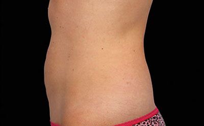 CoolSculpting case #1866