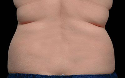 Coolsculpting Before and After Results | Geria Dermatology New Jersey