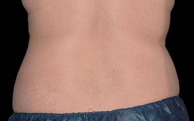 Coolsculpting Before and After Results | Geria Dermatology New Jersey