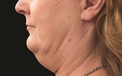 Coolsculpting Before and After Results | Geria Dermatology New Jersey