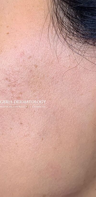 Dermaplaning case #1921