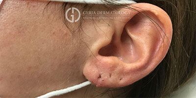 Earlobe Repair Before and After Results | Geria Dermatology New Jersey
