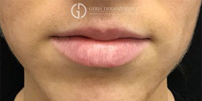 Lip Filler case #2133