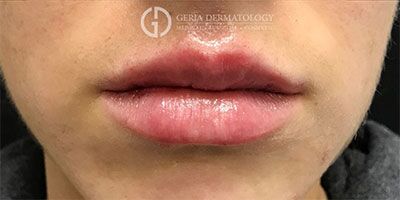 Lip Filler case #2133