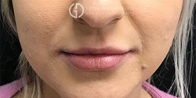 Lip Filler case #2136