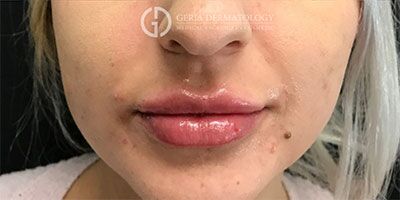 Lip Filler case #2136