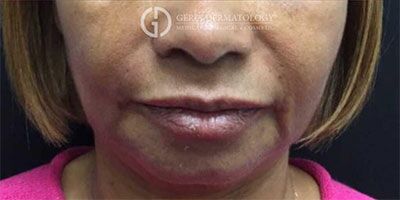 Nasolabial Fold Filler case #2160