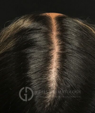 PRP Hair Restoration case #2222