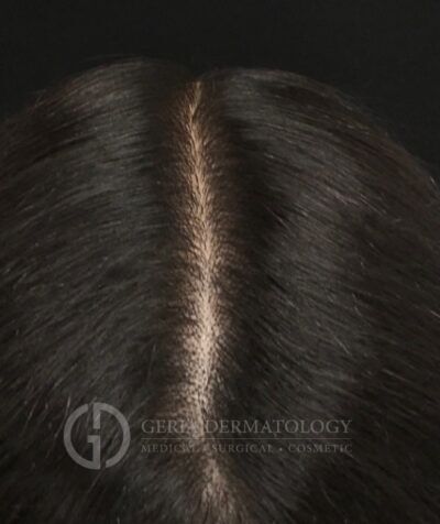 PRP Hair Restoration case #2222